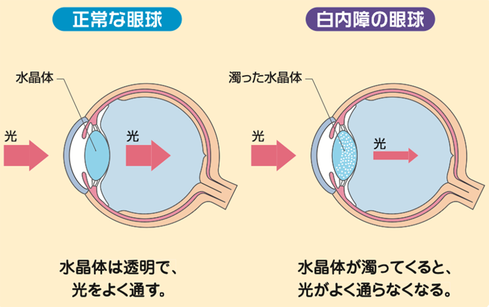 白内障 | 大宮いけだ眼科