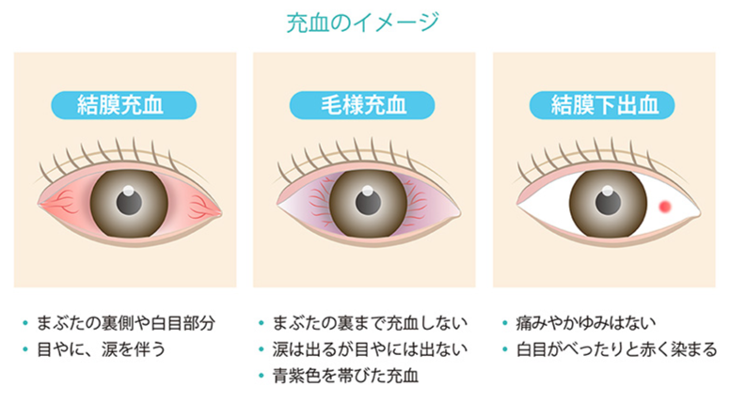 症状別トピック 大宮いけだ眼科