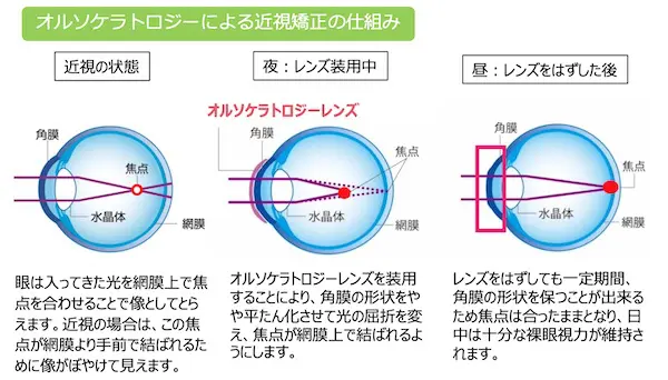 オルソケラトロジー 大宮いけだ眼科